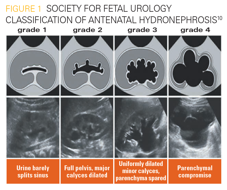 What Is Grade 1 Hydronephrosis Picture Of Drone